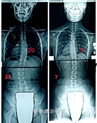 10歲脊椎側彎女孩  胸椎20度 腰椎25度